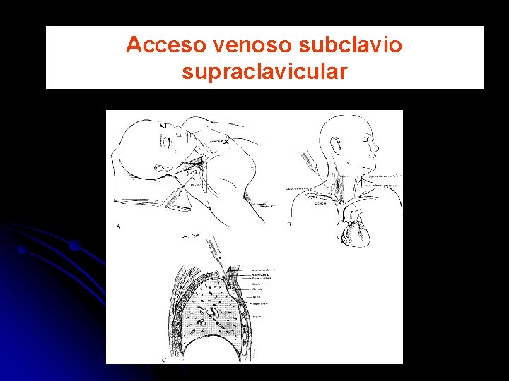 Acceso venoso subclavio supraclavicular 