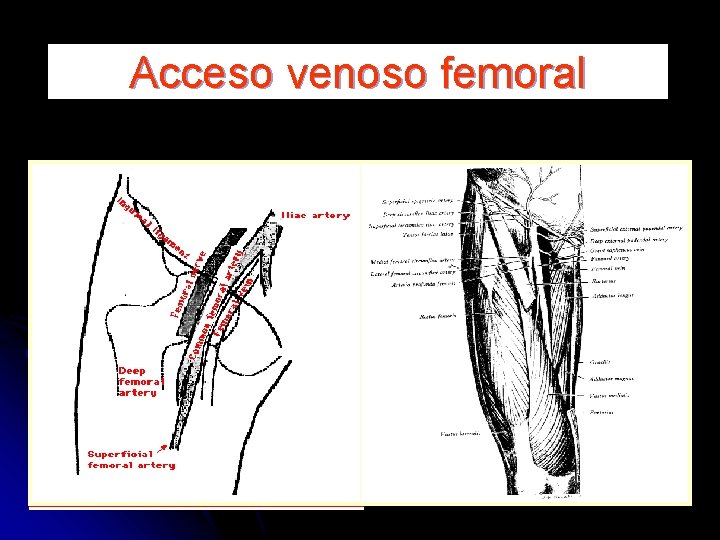 Acceso venoso femoral 