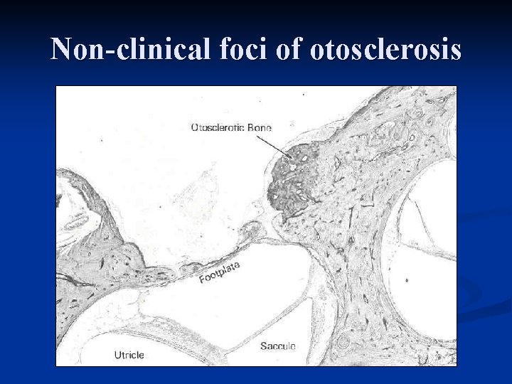 Non-clinical foci of otosclerosis 
