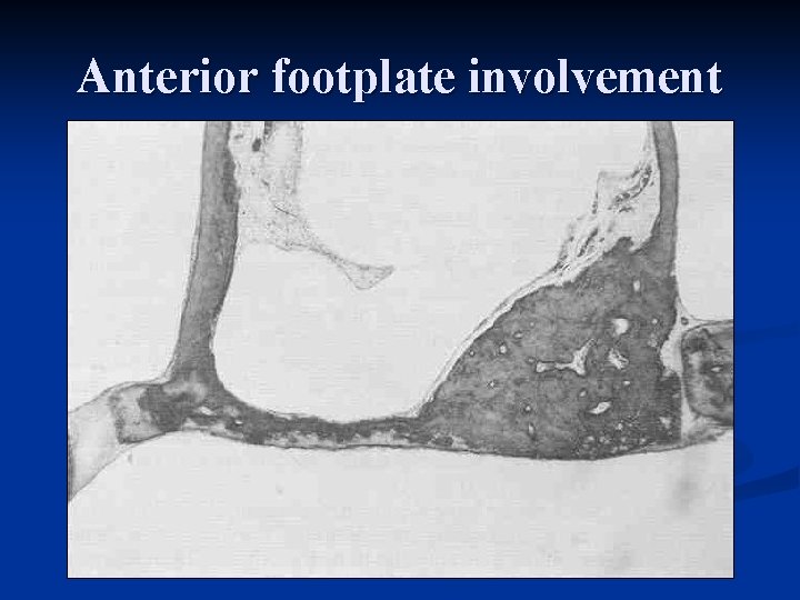 Anterior footplate involvement 