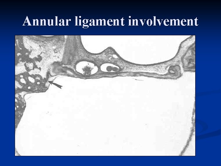 Annular ligament involvement 