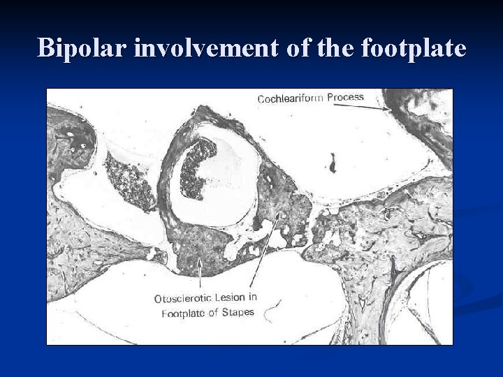 Bipolar involvement of the footplate 