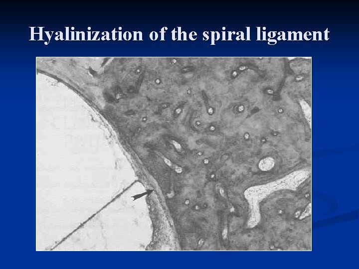 Hyalinization of the spiral ligament 