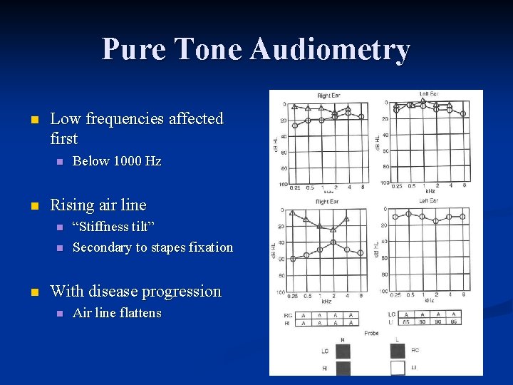 Pure Tone Audiometry n Low frequencies affected first n n Rising air line n