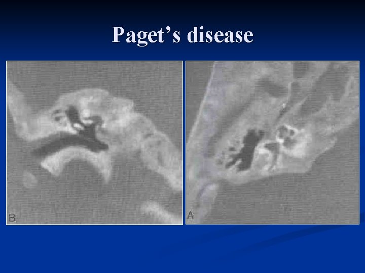 Paget’s disease 