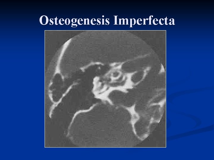 Osteogenesis Imperfecta 