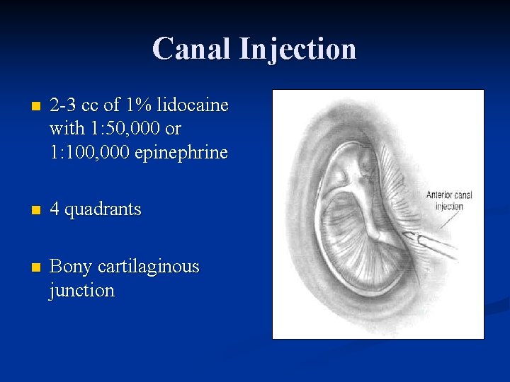 Canal Injection n 2 -3 cc of 1% lidocaine with 1: 50, 000 or