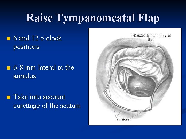 Raise Tympanomeatal Flap n 6 and 12 o’clock positions n 6 -8 mm lateral