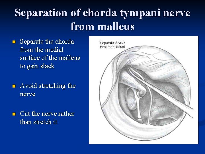 Separation of chorda tympani nerve from malleus n Separate the chorda from the medial