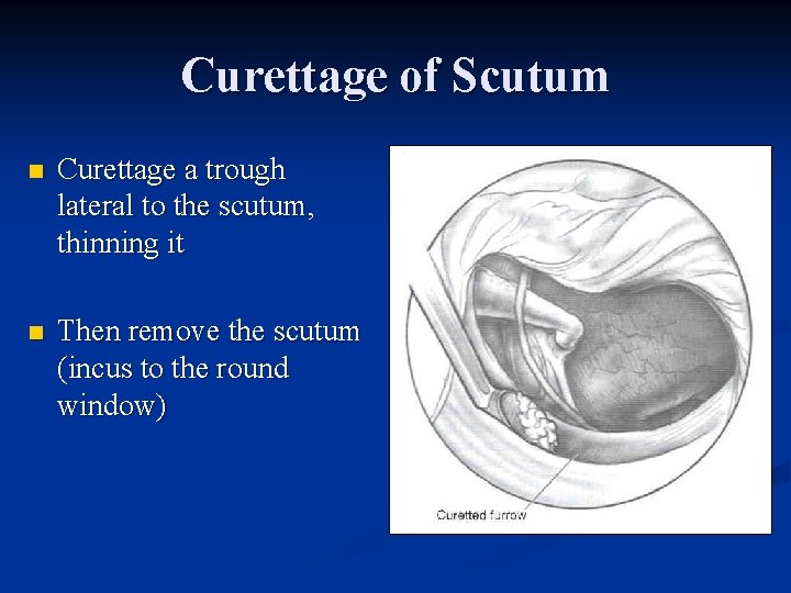 Curettage of Scutum n Curettage a trough lateral to the scutum, thinning it n