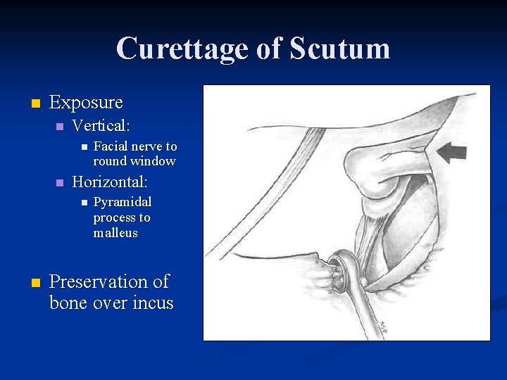 Curettage of Scutum n Exposure n Vertical: n n Horizontal: n n Facial nerve