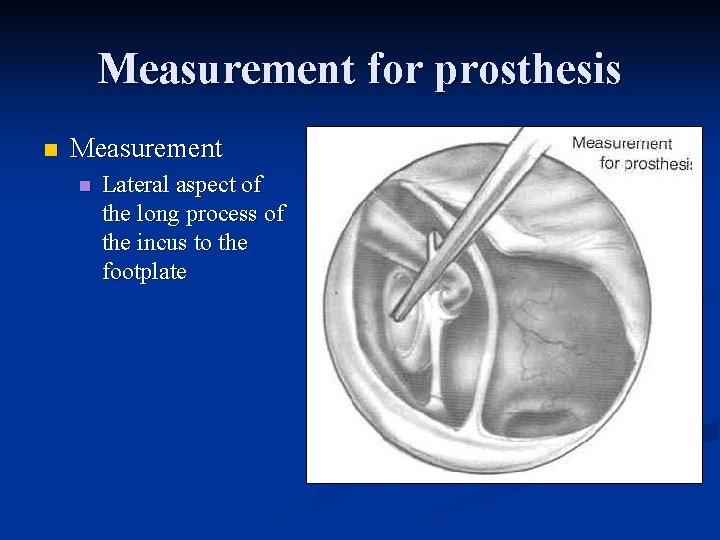 Measurement for prosthesis n Measurement n Lateral aspect of the long process of the