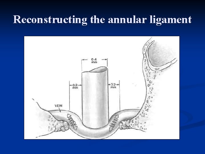 Reconstructing the annular ligament 