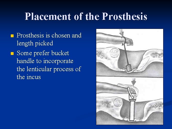 Placement of the Prosthesis n n Prosthesis is chosen and length picked Some prefer