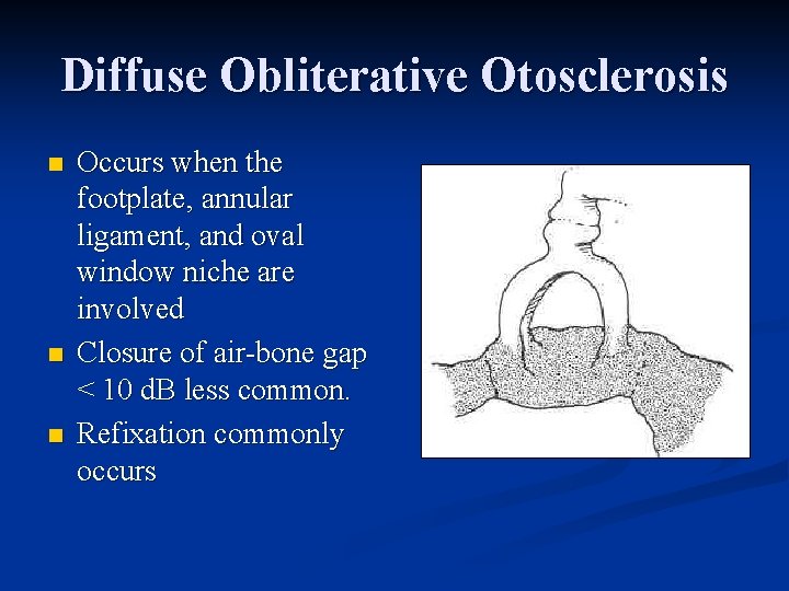 Diffuse Obliterative Otosclerosis n n n Occurs when the footplate, annular ligament, and oval