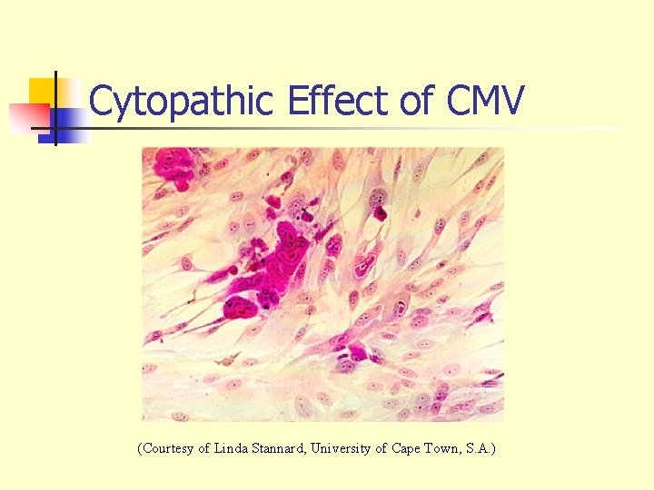 Cytopathic Effect of CMV (Courtesy of Linda Stannard, University of Cape Town, S. A.