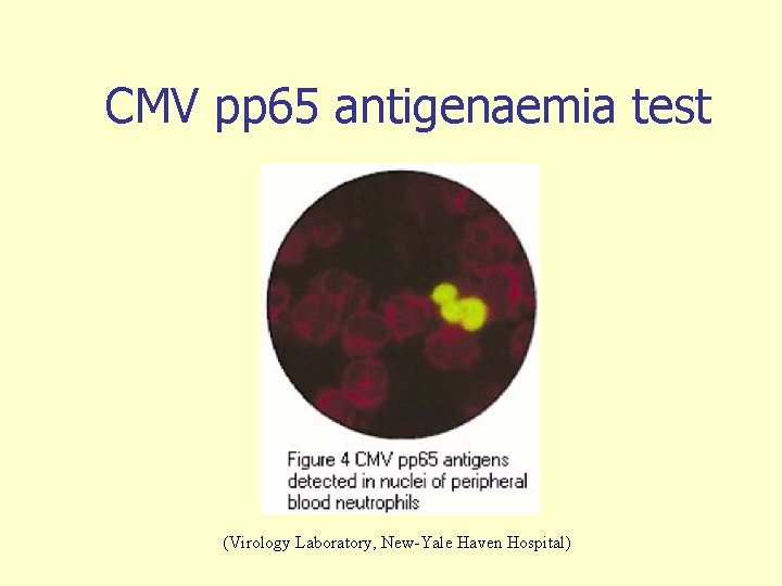 CMV pp 65 antigenaemia test (Virology Laboratory, New-Yale Haven Hospital) 