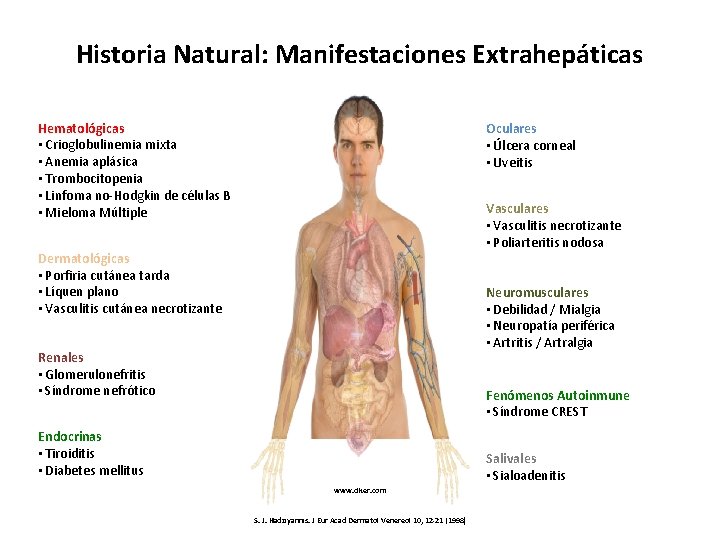 Historia Natural: Manifestaciones Extrahepáticas Hematológicas • Crioglobulinemia mixta • Anemia aplásica • Trombocitopenia •