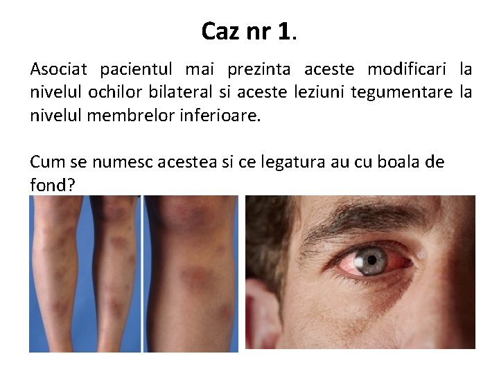 Caz nr 1. Asociat pacientul mai prezinta aceste modificari la nivelul ochilor bilateral si
