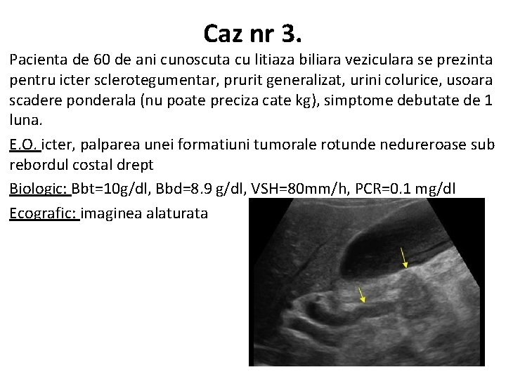 Caz nr 3. Pacienta de 60 de ani cunoscuta cu litiaza biliara veziculara se