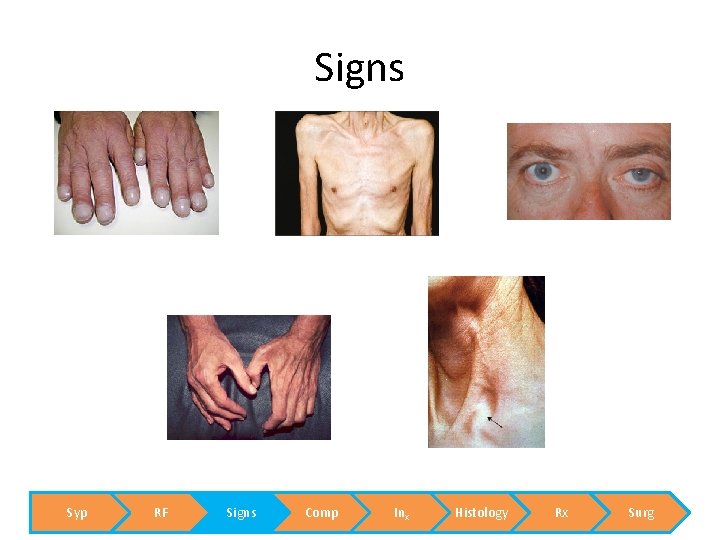 Signs Syp RF Signs Comp Inx Histology Rx Surg 
