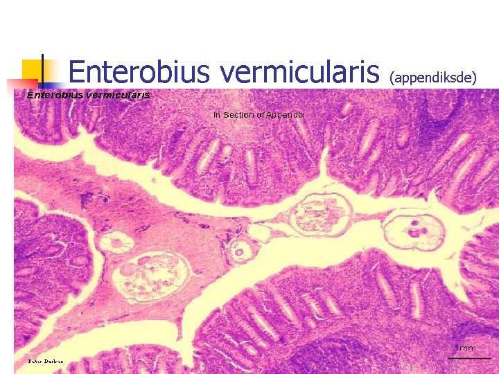 Enterobius vermicularis (appendiksde) 