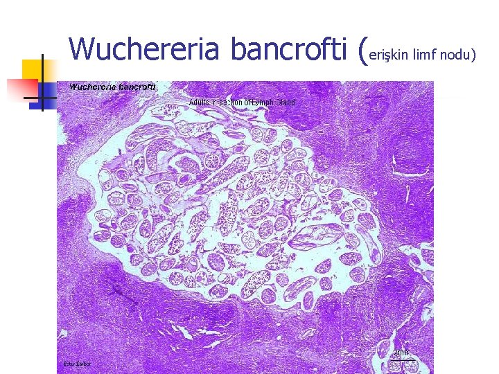 Wuchereria bancrofti (erişkin limf nodu) 