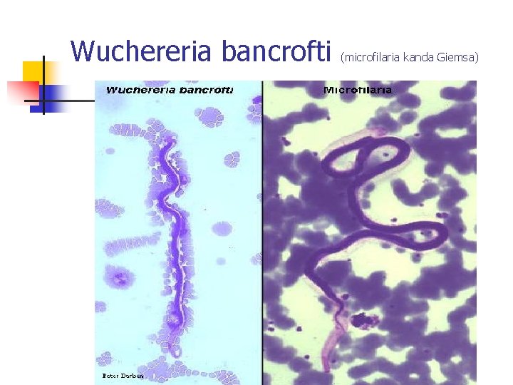 Wuchereria bancrofti (microfilaria kanda Giemsa) 