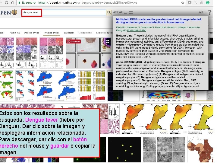 Estos son los resultados sobre la búsqueda: Dengue fever (fiebre por Dengue). Dar clic