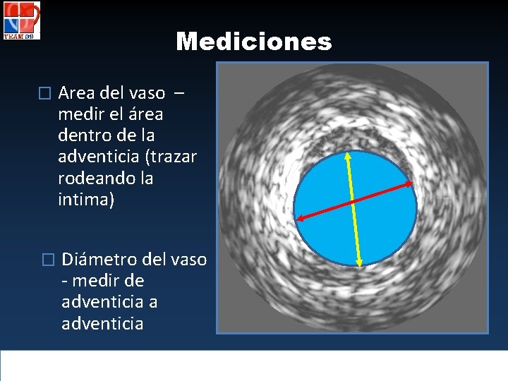 Mediciones � Area del vaso – medir el área dentro de la adventicia (trazar