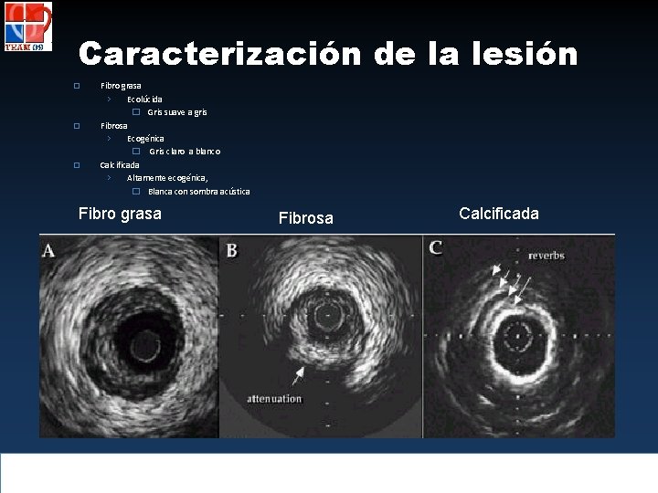 Caracterización de la lesión � � � Fibro grasa › Ecolúcida � Gris suave