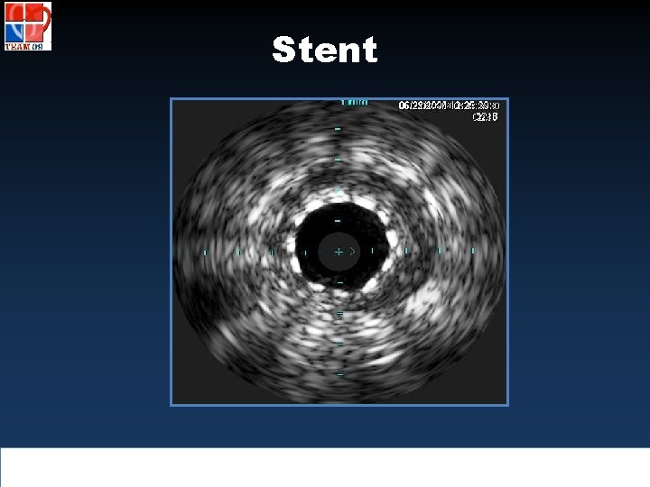 Stent 