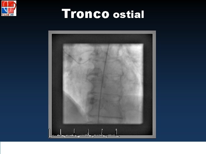 Tronco ostial 