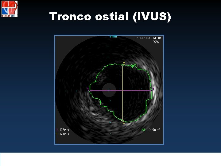 Tronco ostial (IVUS) 