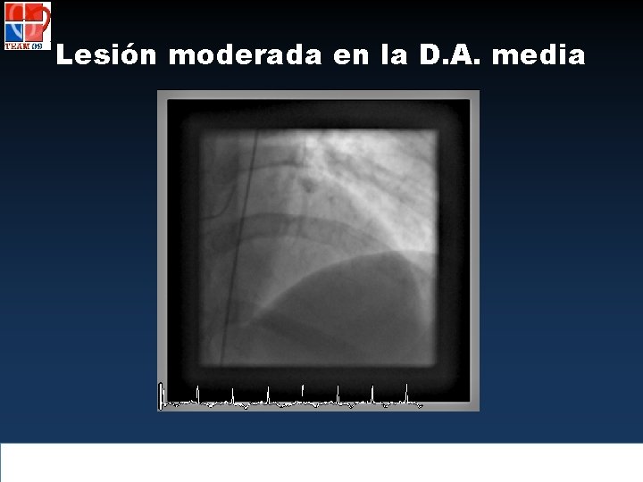 Lesión moderada en la D. A. media 