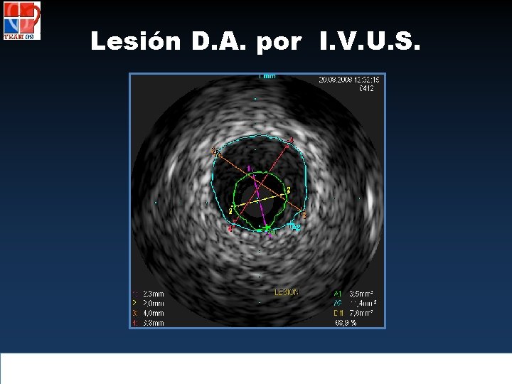 Lesión D. A. por I. V. U. S. 