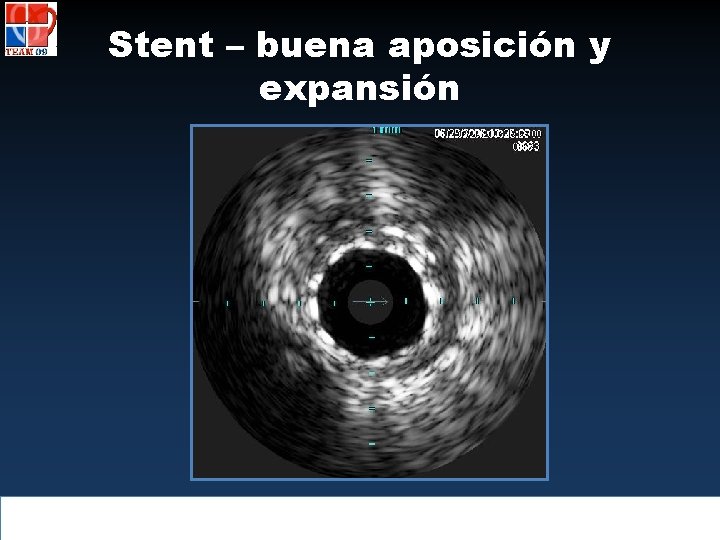 Stent – buena aposición y expansión 