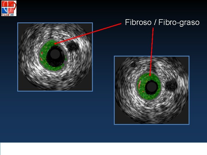 Fibroso / Fibro-graso 