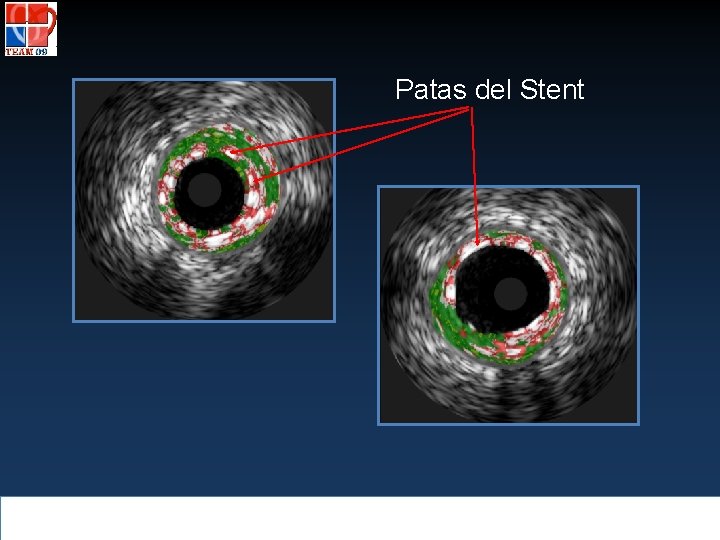 Patas del Stent 
