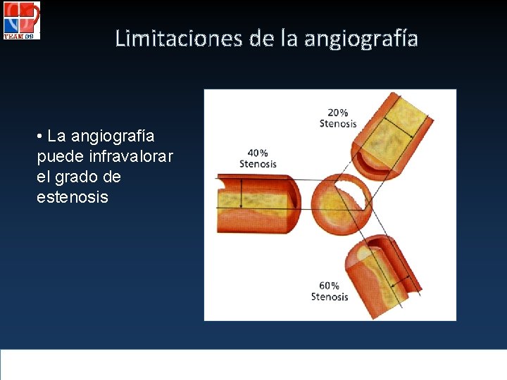 Limitaciones de la angiografía • La angiografía puede infravalorar el grado de estenosis 