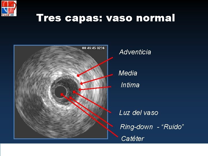 Tres capas: vaso normal Adventicia Media Intima Luz del vaso Ring-down - “Ruido” Catéter