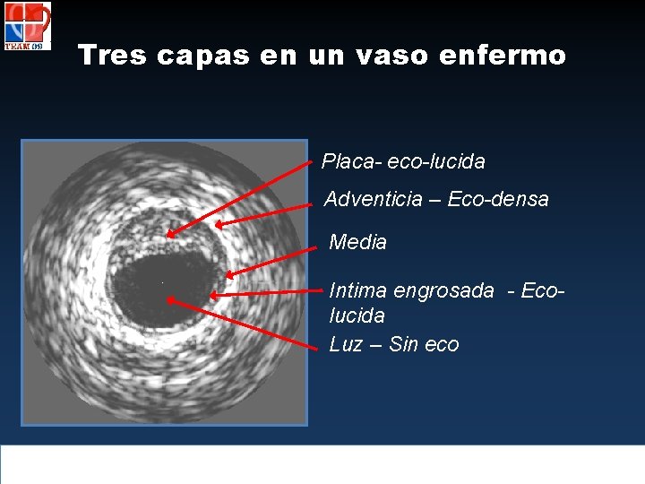 Tres capas en un vaso enfermo Placa- eco-lucida Adventicia – Eco-densa Media Intima engrosada