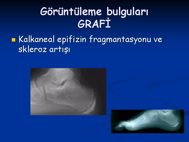 Görüntüleme bulguları GRAFİ n Kalkaneal epifizin fragmantasyonu ve skleroz artışı 