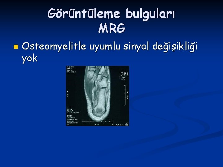 Görüntüleme bulguları MRG n Osteomyelitle uyumlu sinyal değişikliği yok 