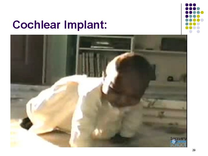 Cochlear Implant: 29 