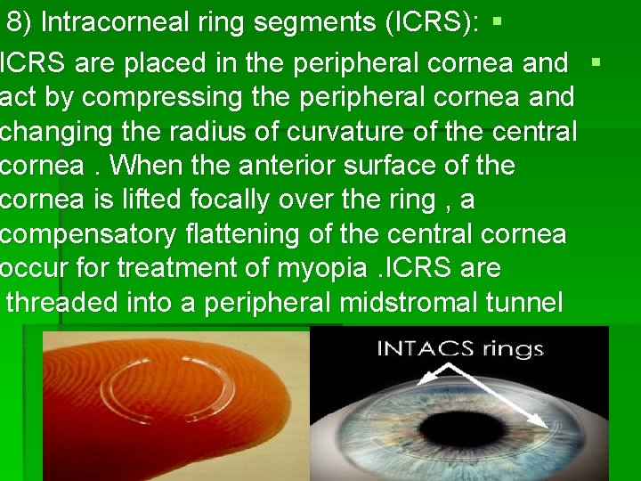 8) Intracorneal ring segments (ICRS): § ICRS are placed in the peripheral cornea and