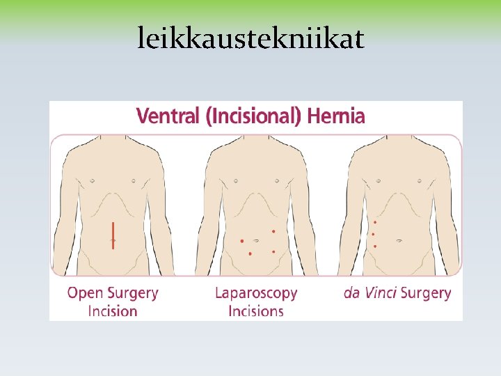 leikkaustekniikat leikkaustekniikat