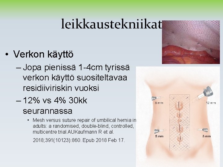 leikkaustekniikat • Verkon käyttö – Jopa pienissä 1 -4 cm tyrissä verkon käyttö suositeltavaa