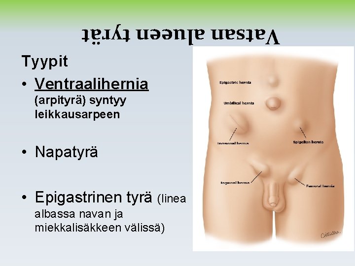 Vatsan alueen tyrät Tyypit • Ventraalihernia (arpityrä) syntyy leikkausarpeen • Napatyrä • Epigastrinen tyrä