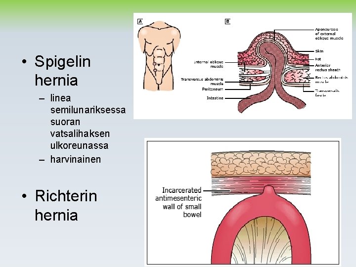  • Spigelin hernia – linea semilunariksessa suoran vatsalihaksen ulkoreunassa – harvinainen • Richterin